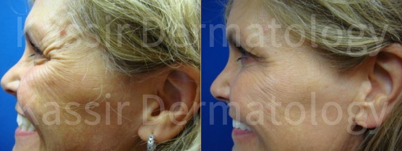 Dysport ® Injections dallas image