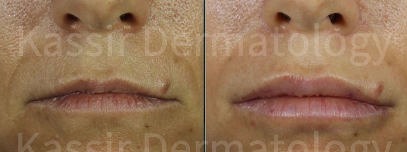 Injectable Dermal Fillers dallas image