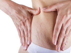 Stretch Marks Treatment dallas