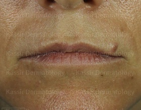 Injectable Dermal Fillers dallas