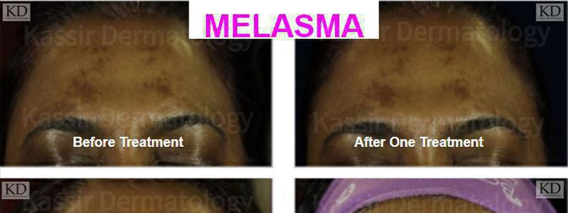 Melasma Treatment dallas image