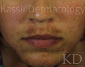 Melasma Treatment dallas