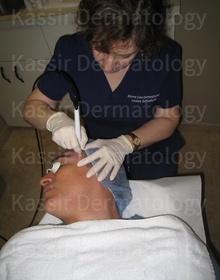 Microdermabrasion dallas