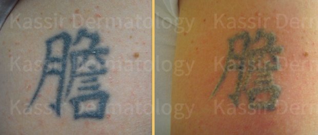 Removing Red Ink with 532nm at Newcastle Tattoo Removal  YouTube