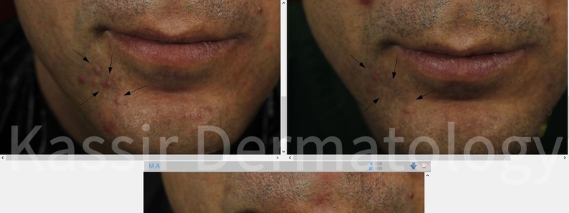 Acne Treatment dallas image