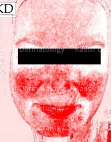 Rosacea dallas