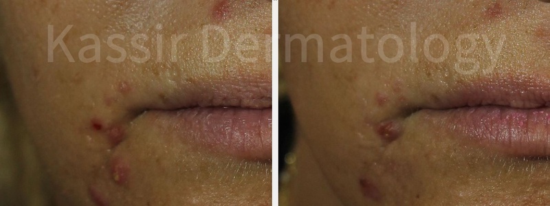 Acne Treatment dallas image