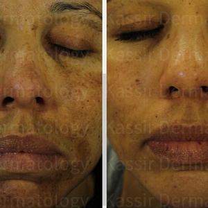 Pigmented Lesions dallas