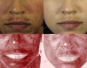 Melasma Treatment dallas