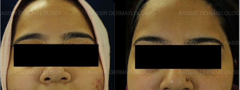 Acne Treatment dallas image