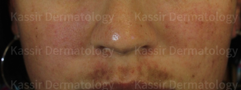 Pigmented Lesions dallas image