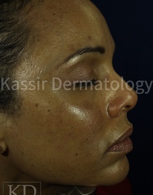 Melasma Treatment dallas