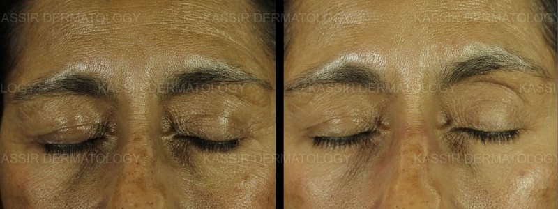 Skin Rejuvenation dallas image