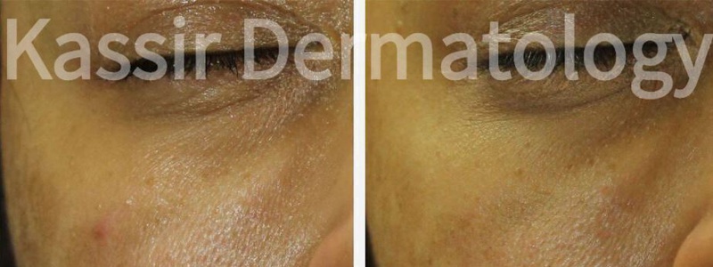 Melasma Treatment dallas image