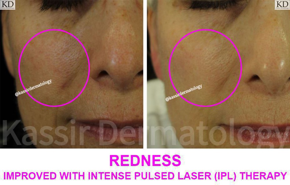 IPL Photofacial Gallery | Dermatology Gallery in | Kassir Dermatology, Cosmetic Dermatologist Dallas TX