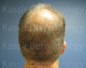 Hair Loss dallas