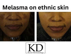 Melasma Treatment dallas