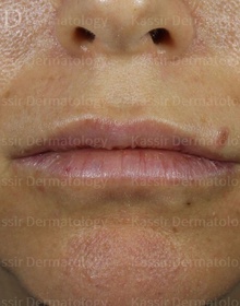 Injectable Dermal Fillers dallas