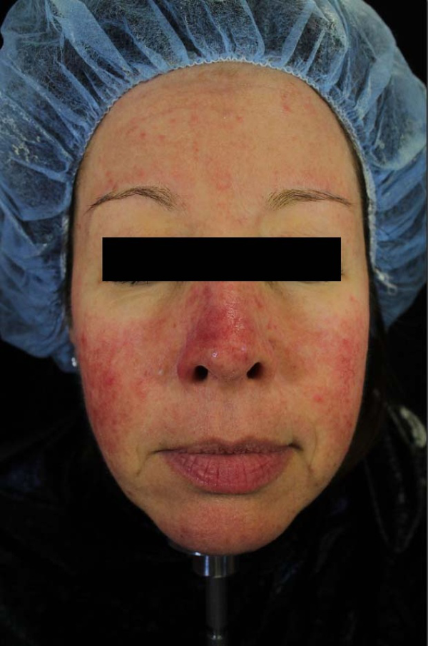 Rosacea Treatment Redness Or Flushing Rosacea Treatment For Flushing