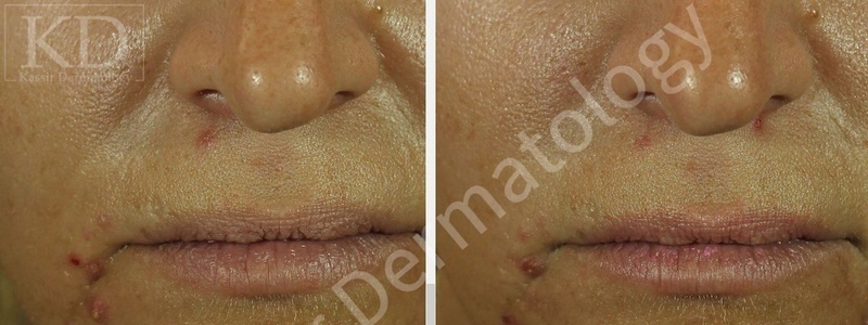 Acne Treatment dallas image