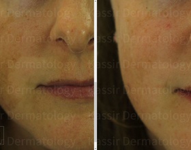 Melasma Treatment dallas