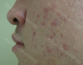 Acne Treatment dallas