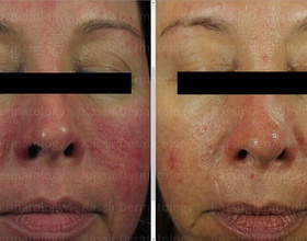 Rosacea dallas