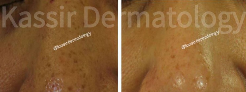 Micro-Needling dallas image