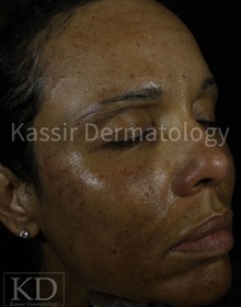 Melasma Treatment dallas