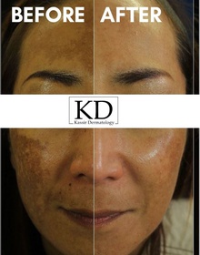 Melasma Treatment dallas