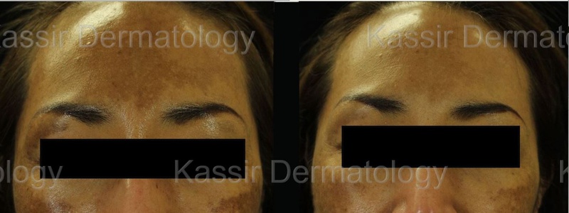 Melasma Treatment dallas image