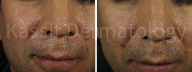Acne Treatment dallas image