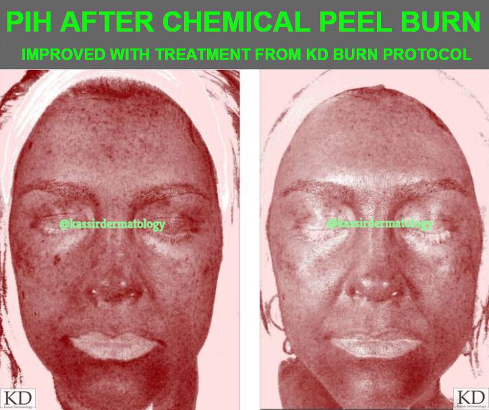 Chemical peels from a dermatologist