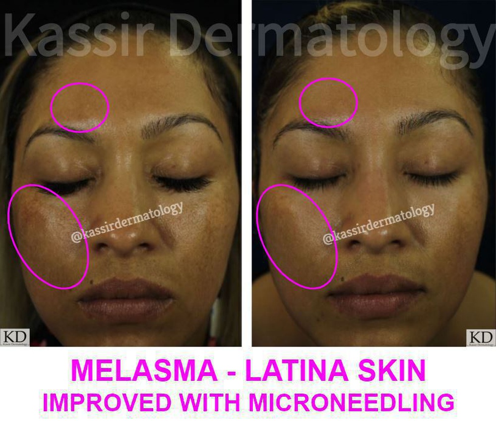 MicroNeedling Gallery Dermatology Gallery in Dallas Kassir