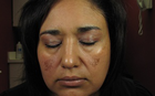 Melasma Treatment dallas