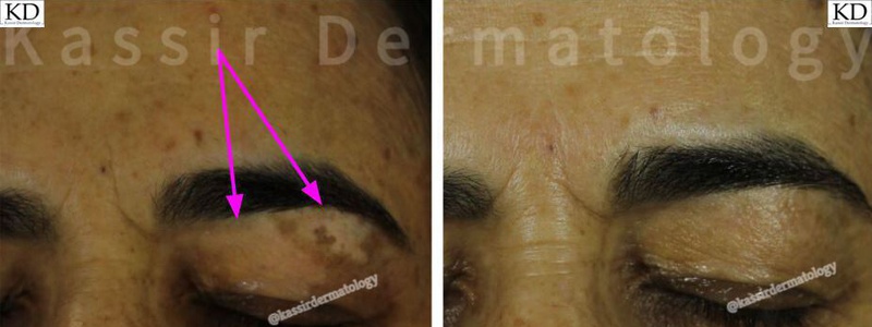 Pigmented Lesions dallas image