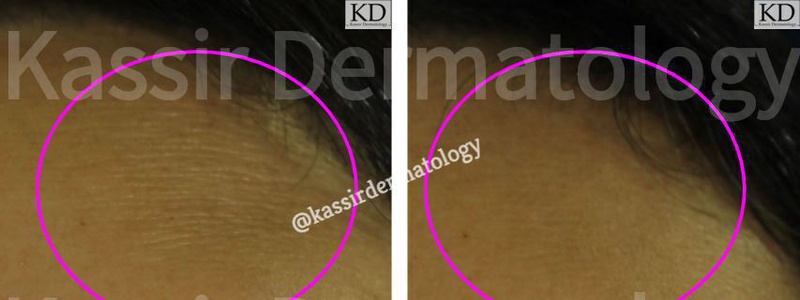 Micro-Needling dallas image